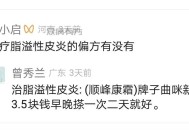 治疗脂溢性皮炎的偏方有没有或者什么要好用